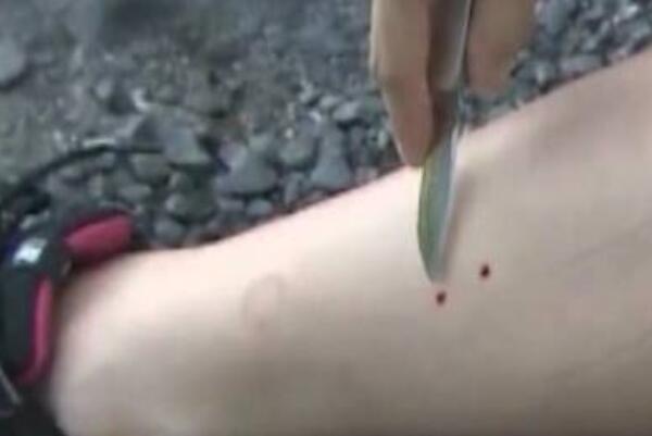 用嘴吸蛇毒的做法是正确的吗：不正确(会加速毒液扩散)