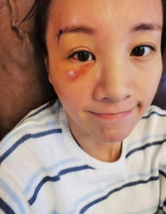 ​陈龙娇妻章龄之受伤后晒照，淤青红肿触目惊心，遭“破相”仍美丽